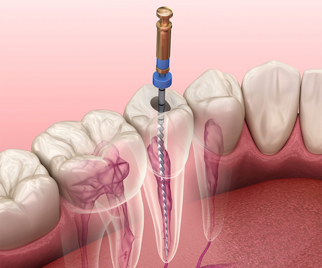 عصب کشی ریشه دندان