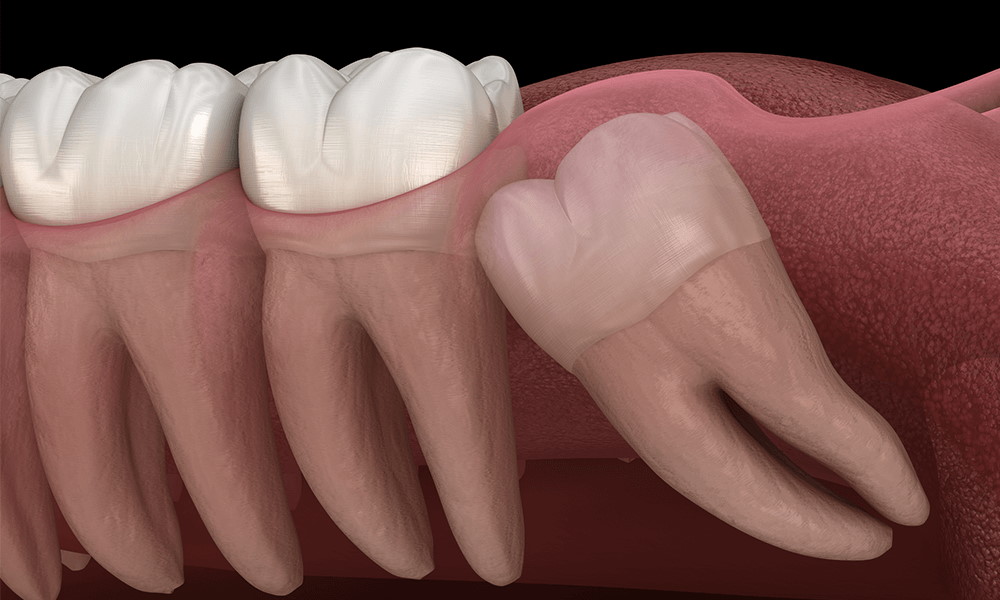 دندان عقل چیست